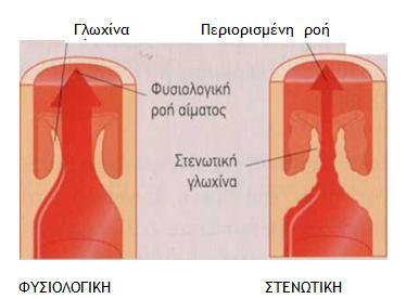 Στένωση Τριγλωχίνας Βαλβίδας