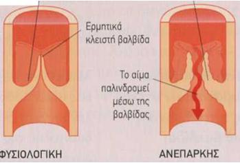 Ανεπάρκεια Τριγλωχίνας Βαλβίδας